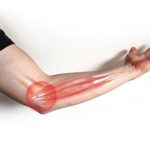 Golfer’s Elbow: Causes, Symptoms, and Treatment