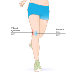 Runner’s Knee (Patellofemoral Pain Syndrome): Causes and Treatments