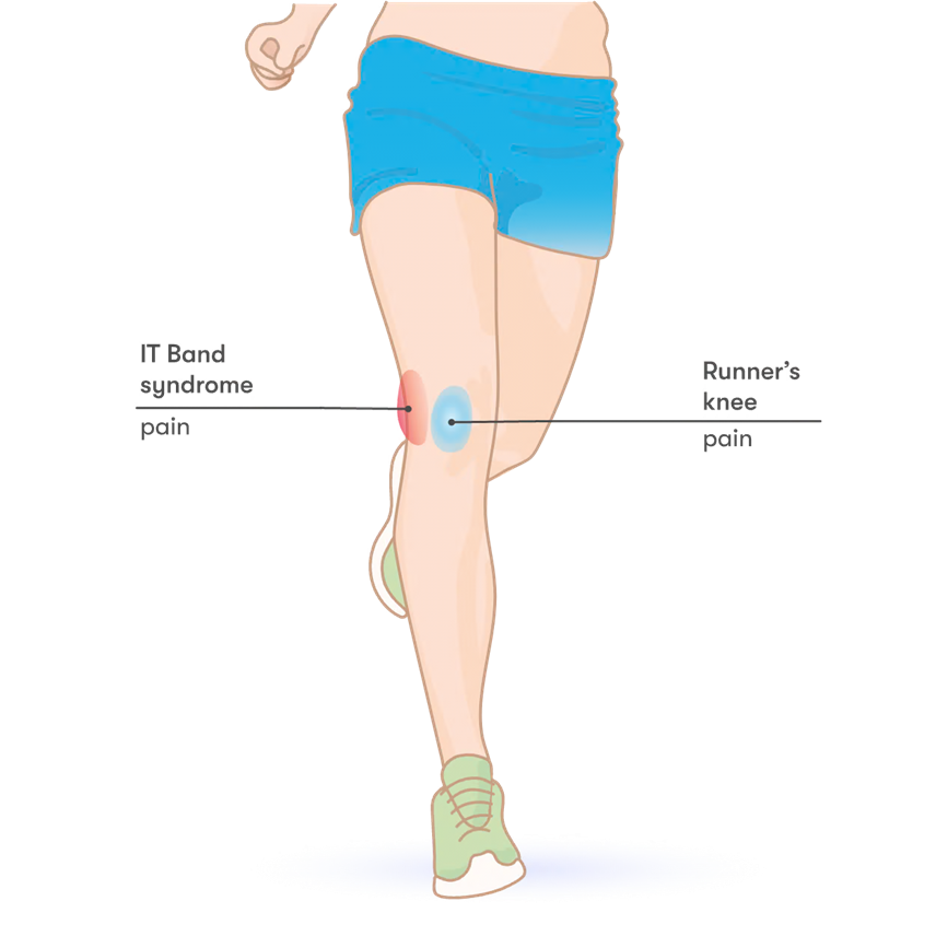 Runner’s Knee (Patellofemoral Pain Syndrome): Causes and Treatments