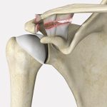 AC Joint Separation