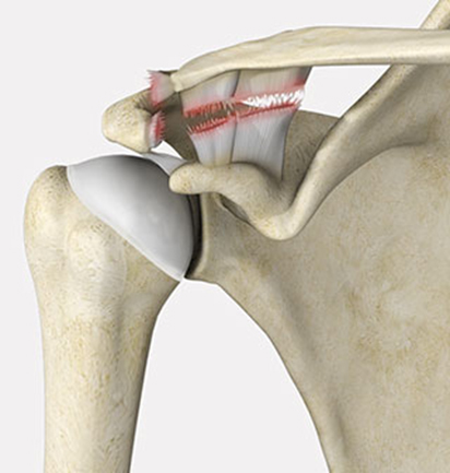 AC Joint Separation