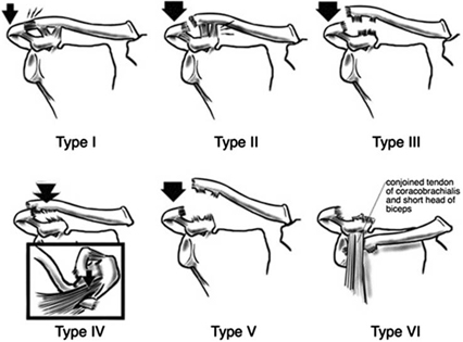 Acromioclavicular (AC) Joint Injuries