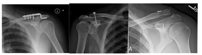 Acromioclavicular Ligament repair
