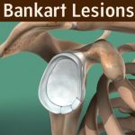 Bankart Lesion