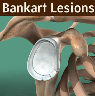 Bankart Lesion