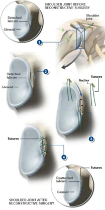Bankart Lesion