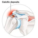 Calcific Shoulder Tendonitis