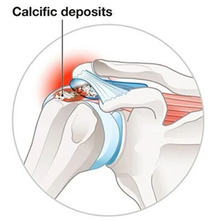 Calcific Shoulder Tendonitis