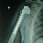 Hemiarthroplasty in Proximal Humerus
