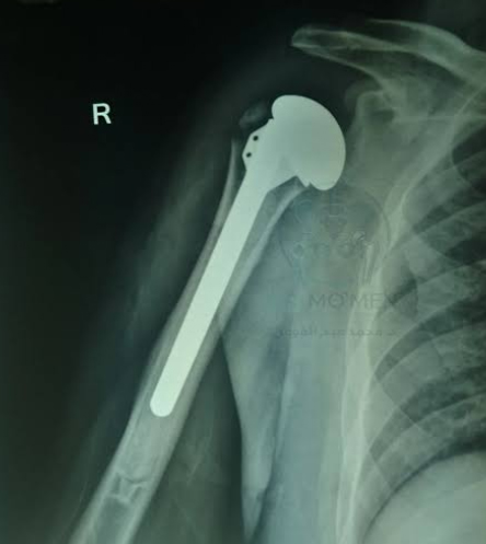 Hemiarthroplasty in Proximal Humerus