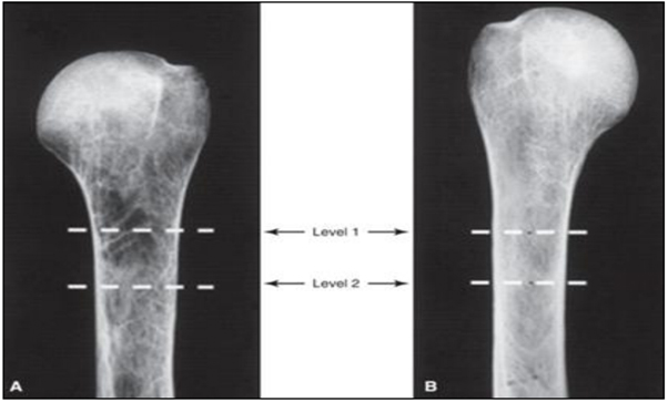Hemiarthroplasty