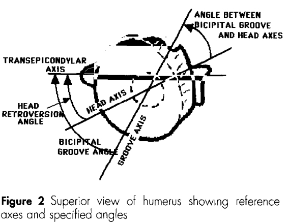 Fracture Hemiarthroplasty