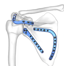 Implants