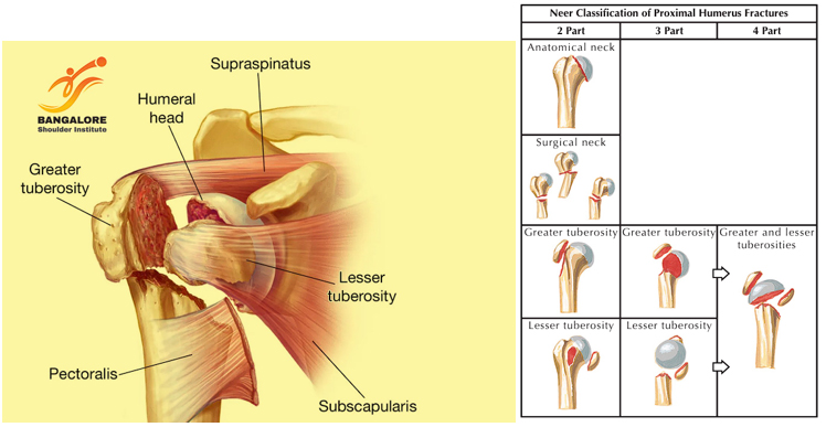 Proximal Humerus Fractures