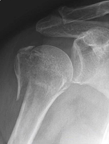 Humerus Fractures