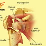 Proximal Humerus Fractures