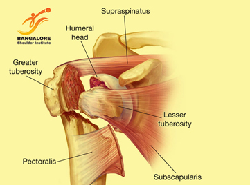Proximal Humerus Fractures