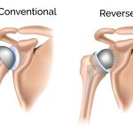 Reverse Shoulder Arthroplasty