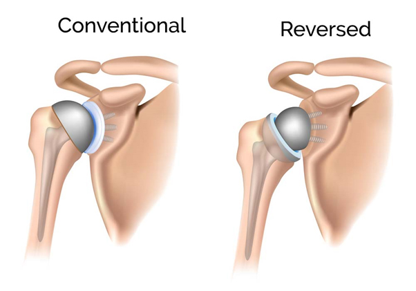 Reverse Shoulder Arthroplasty