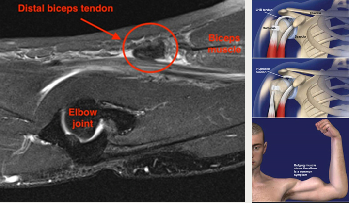 Biceps Tendon Rupture