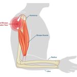 Biceps Tendon Rupture