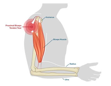 Biceps Tendon Rupture