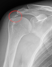 Calcific Tendinopathy of the Shoulder
