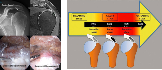Calcific Tendinopathy of the Shoulder