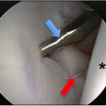 Cartilage Defects of Shoulders
