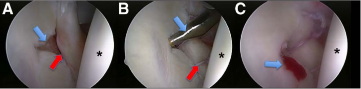 Cartilage Defects of Shoulders