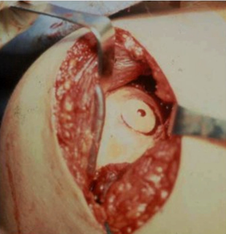 Cartilage Defects With Shoulder 