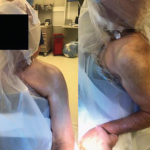 Deltopectoral Approach in Shoulder Arthroplasty