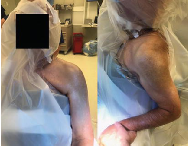 Deltopectoral Approach in Shoulder Arthroplasty