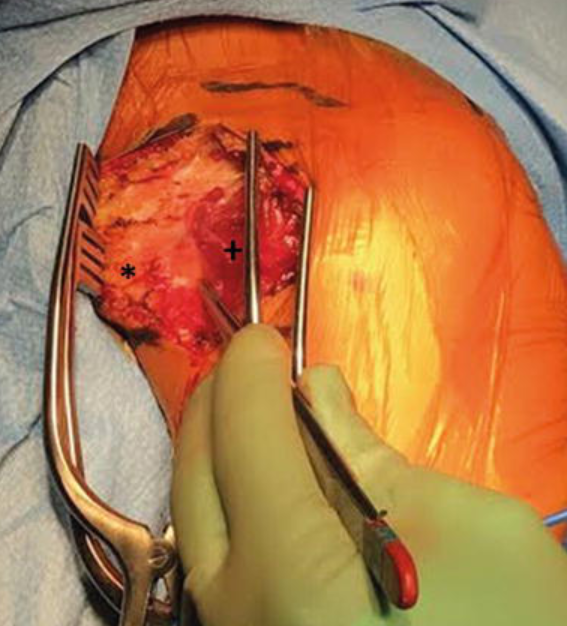 Deltopectoral Approach in Shoulder Arthroplasty