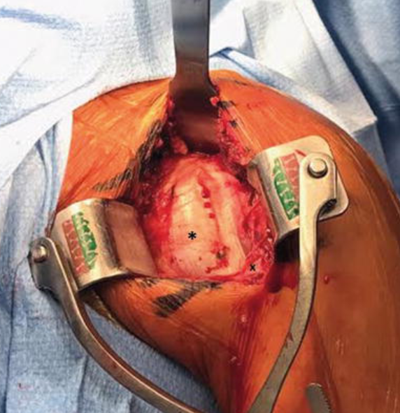 Shoulder Arthroplasty
