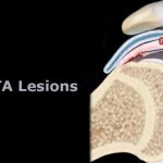 Pasta Lesions
