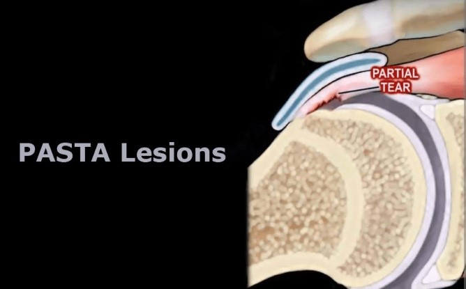 Pasta Lesions