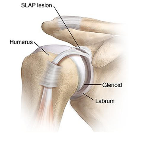 Slap Lesion