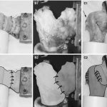 Subscapularis Management
