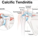 Calcific Tendinopathy of the Shoulder