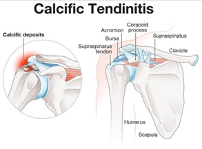 Calcific Tendinopathy of the Shoulder