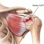 Rotator Cuff Tear