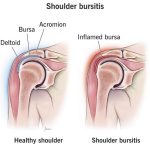 Shoulder Bursitis