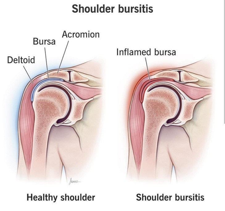 Subacromial Bursitis