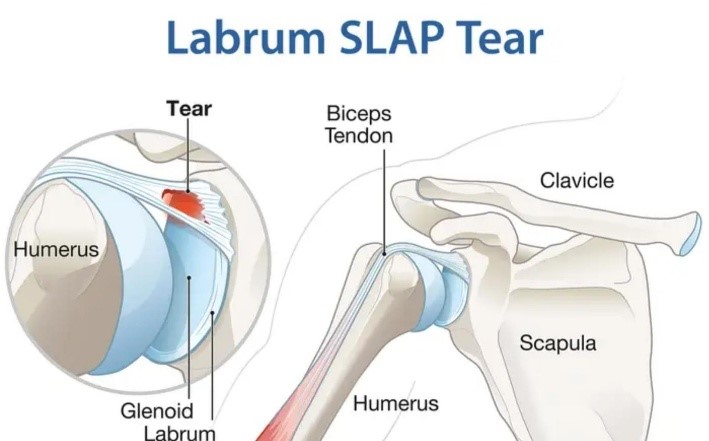 Slap Tear