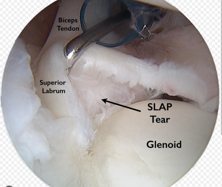 Slap Tear